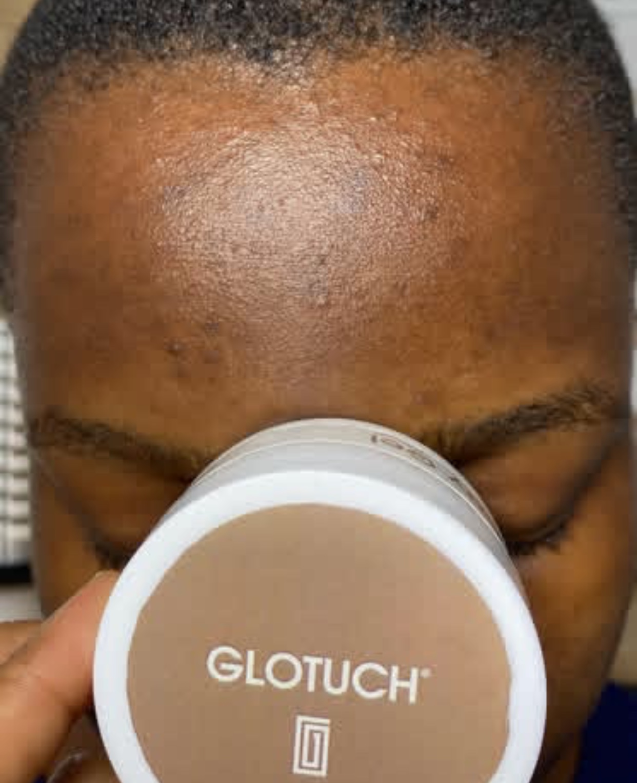 Complete Guide to Treating Acne and Blemishes