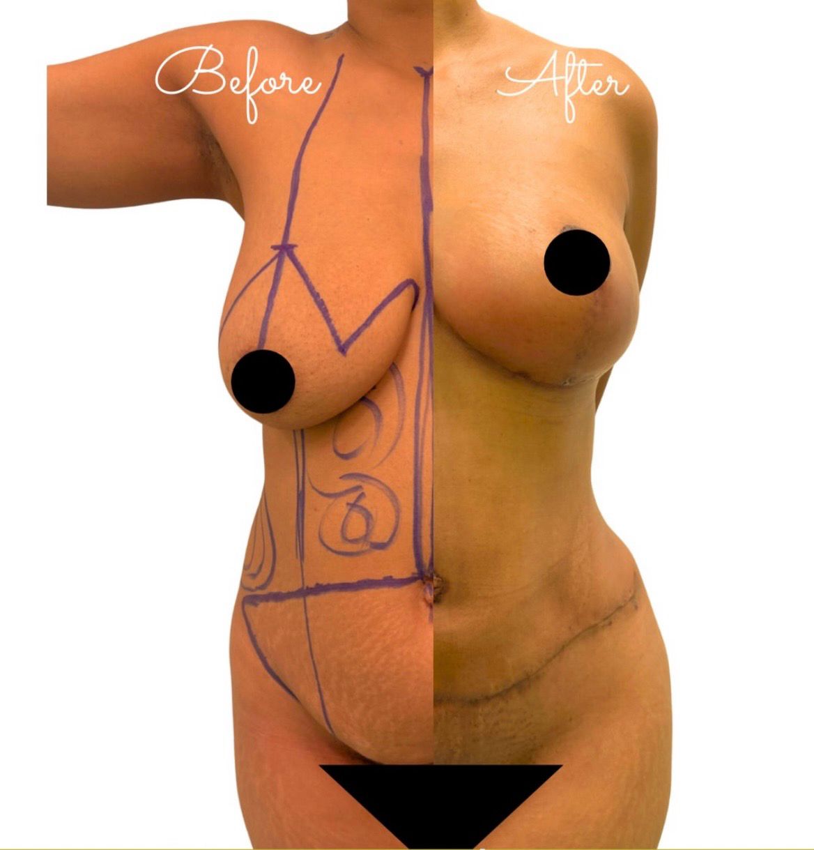 Breast Lift & Tummy Tuck Result