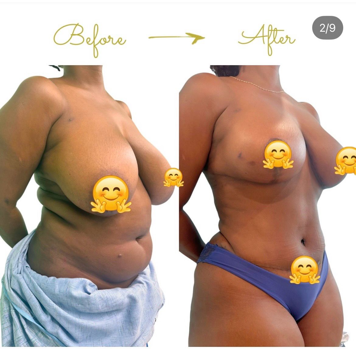 Body Contouring Side View