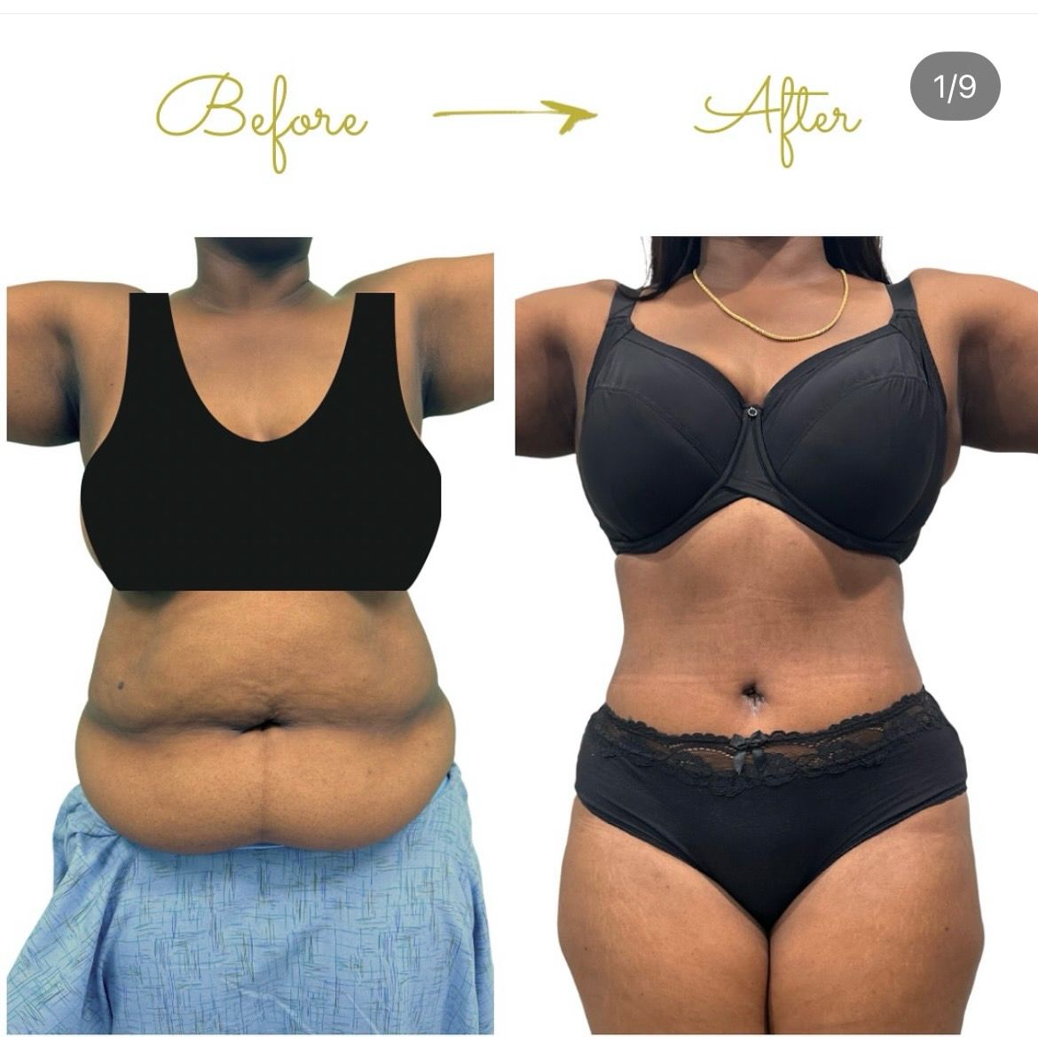 Tummy Tuck Front View