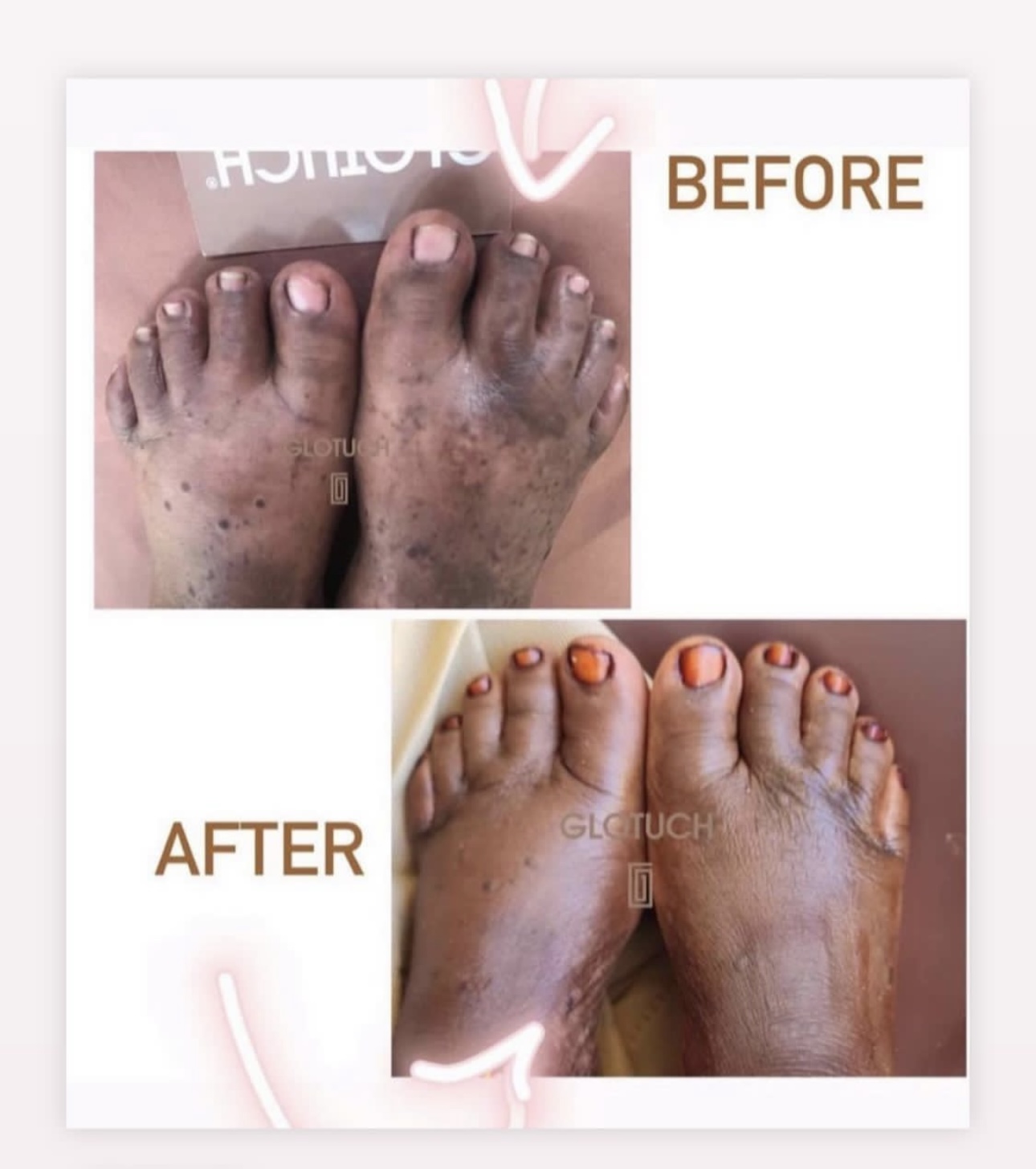 results.footTreatment Results