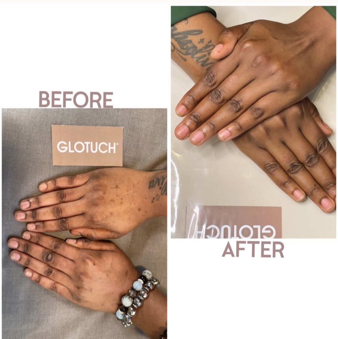 Hand Pigmentation Treatment Results