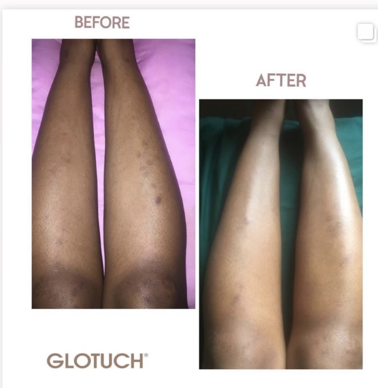 Leg Treatment Results
