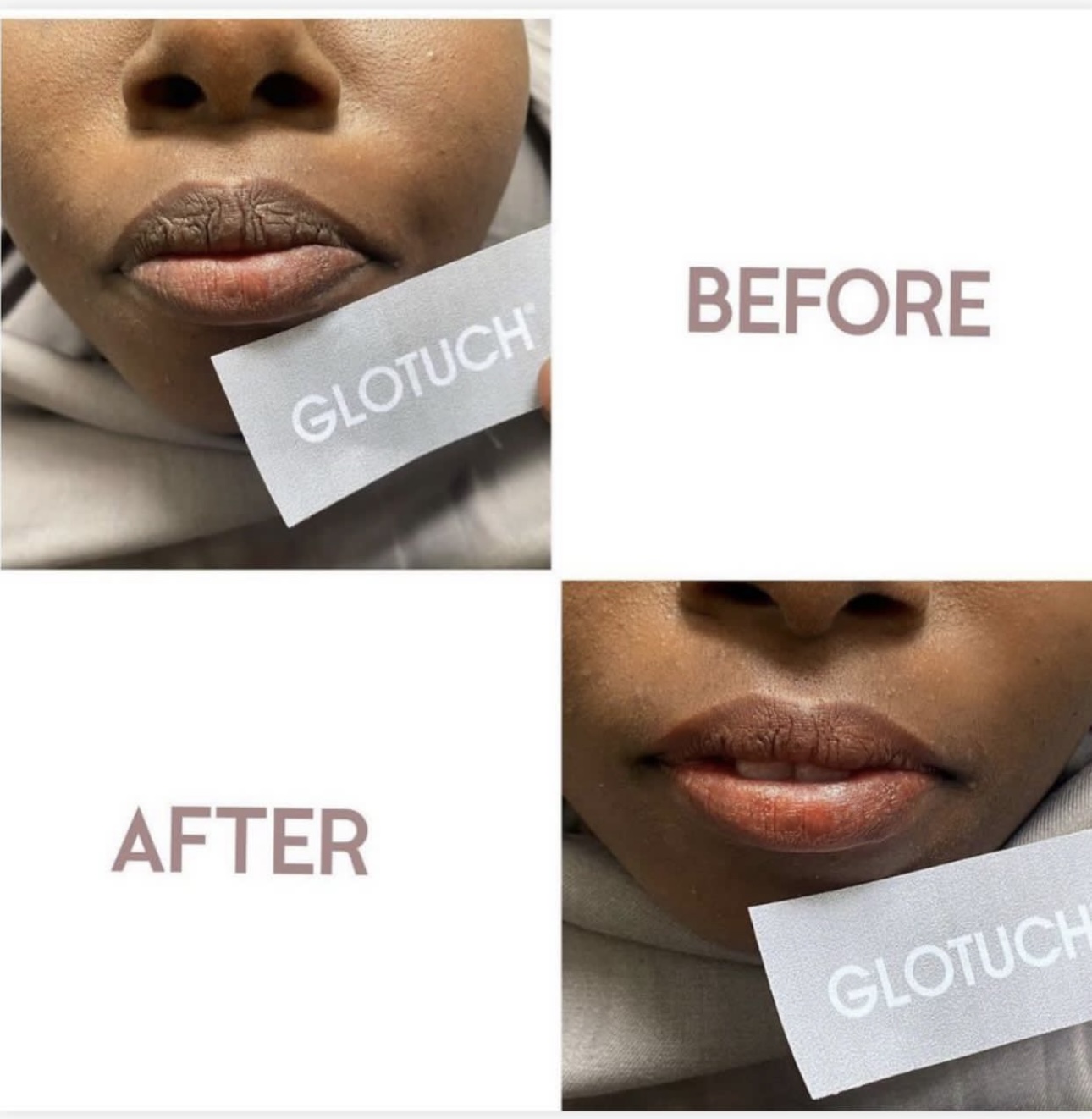Lip Treatment Results