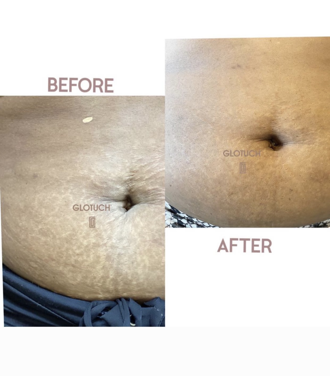 Stretch Mark Treatment Results