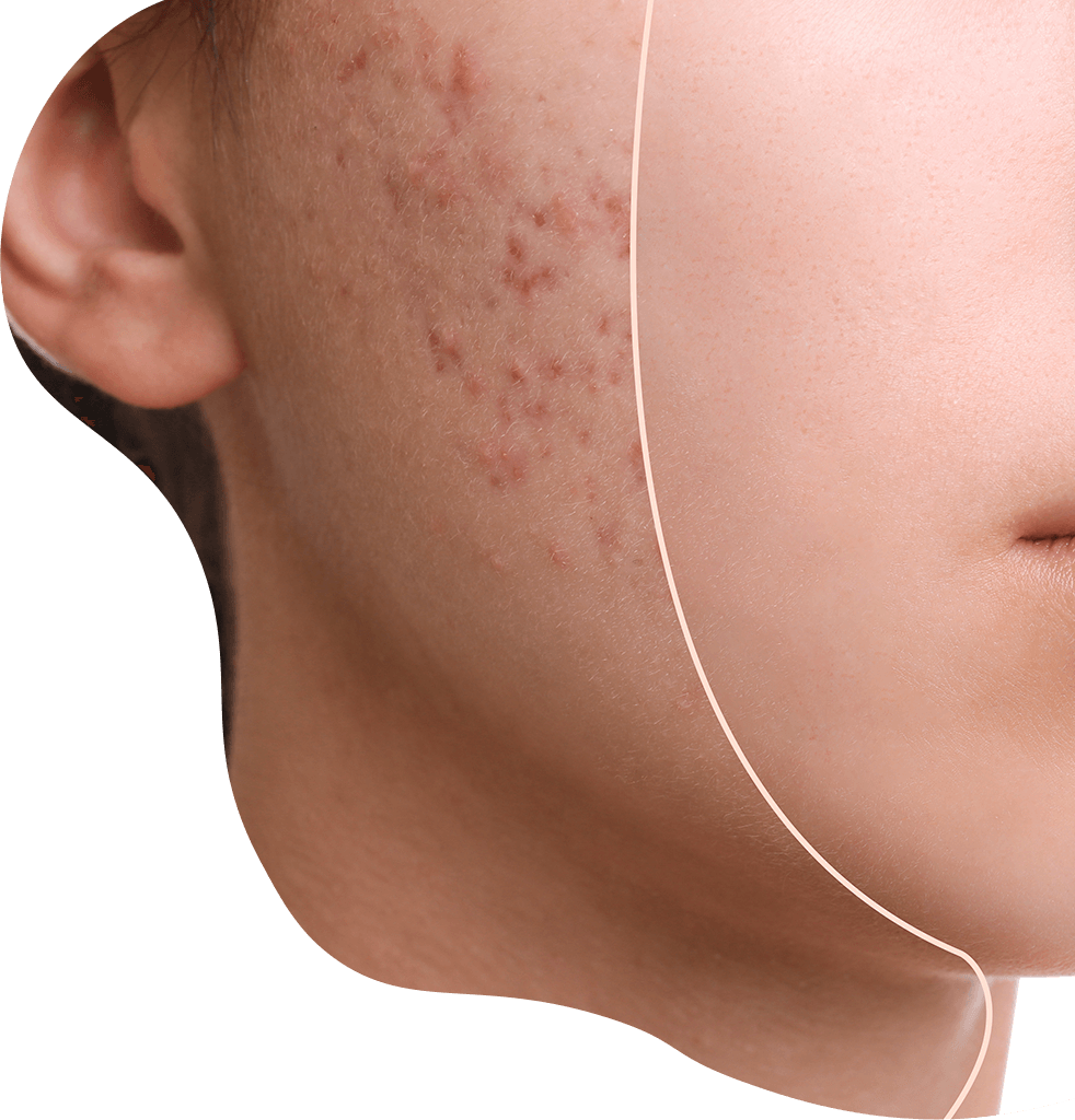 GloaAcne/peel Treatment